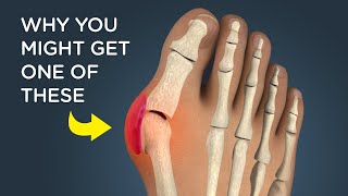 Bunions What Causes Them and How Theyre Removed [upl. by Ajiat]