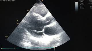 First degree AV block on echocardiography [upl. by Westmoreland]