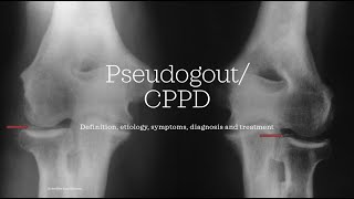 Pseudogout  CPPD Calcium pyrophosphate deposition disease Essential medicine [upl. by Harlie]