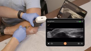 Lateral Epicondyle Injection  Ultrasound Scanning Technique [upl. by Alphonsine]