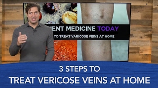 3 Steps to Treat Varicose Veins at Home [upl. by Osanna726]