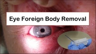 Eye Foreign Body Removal [upl. by Ajaj831]