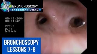 Bronchoscopy Step by Step Details Lessons 78 [upl. by Attaymik]