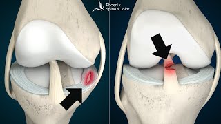 Is your knee pain coming from an ACL tear or Meniscus injury How to tell [upl. by Ahseiyt]