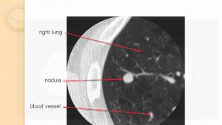 GRACEcast087LungCancerDetection and WorkUp of Lung Nodules by David Yankelevitz [upl. by Ytirev]