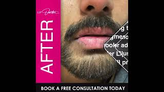 Stunning Lip Brightening Transformation  Pico Laser amp Lip Blush Before and After at Lip Doctor [upl. by Akoek]