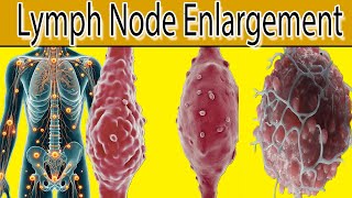 Lymph Node Enlargement  7 Most common causes [upl. by Thetes]