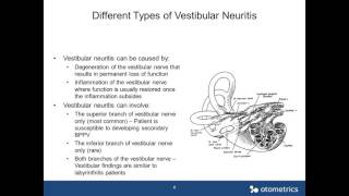 Otometrics Webinar  Vestibular Neuritis How to Identify Different Types [upl. by Darcey831]