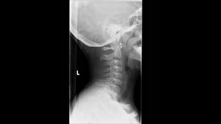 Radiographic Anatomy and Positioning of the Cervical Spine [upl. by Teeniv]