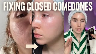 CLOSED COMEDONES  How I cleared my clogged pores routine and products [upl. by Ocisnarf949]