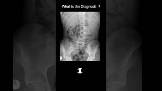 Appendicolith Abdominal Xray  Abnormal calcification 54 radiologychannel007 [upl. by Eeuqram]