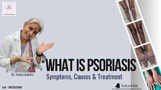 PSORIASIS VULGARIS  Information and treatment by dermatologist  Dr Smita Chakote [upl. by Hgielra]