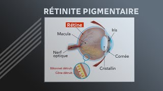 Rétinite pigmentaire  parcourir le monde avant de perdre la vue [upl. by Kareem]