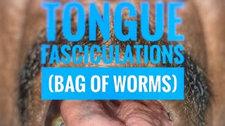 Tongue fasciculations quotBag of wormsquot  mbbs medicine neurology [upl. by Blane]