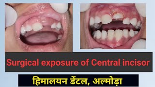 Surgical Tooth Exposure by RF Cautery [upl. by Esekram365]