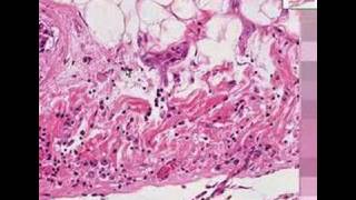 Histopathology Heart pericardiumMetastatic breast carcino [upl. by Batory]