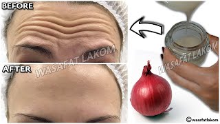 1 onion is a million times stronger than Botox it eliminates wrinkles and fine lines instantly [upl. by Robinett834]