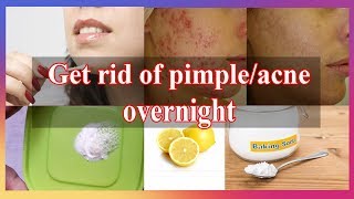 Get rid of pimples overnight  Acne spot treatment  Lemon and Baking soda [upl. by Xila34]