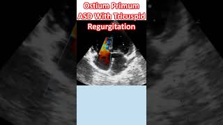 Ostium Primum ASD With Tricuspid Regurgitation [upl. by Hobbs]