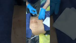 Fat Dissolving Injection to Belly at Beverly Hills Wellness Center amp Med Spa Florida shorts [upl. by Winshell]