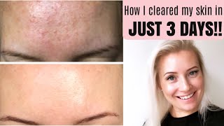 GET RID OF TINY BUMPS ON FOREHEAD FAST  HOW TO TREAT FUNGAL ACNE MALASSEZIA  BEING MRS DUDLEY [upl. by Herve]