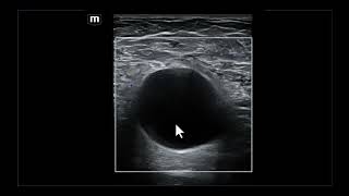 Achados ultrassonográficos e diagnósticos diferenciais da linfocele axilar [upl. by Arted]
