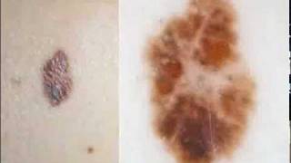 Melanoma criteria 33 by Dr Giuseppe Argenziano [upl. by Aneladdam805]