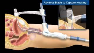 TSPeC® Illustrated Procedure  German [upl. by Marla]