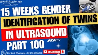 Gender Identification In Ultrasound  Twins Fetus    Part 100 [upl. by Bloxberg823]