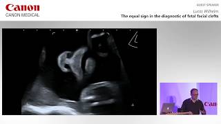 ISUOG  Lucas Wilhelm on the “equal sign” in the diagnosis of fetal facial clefts [upl. by Eerat764]