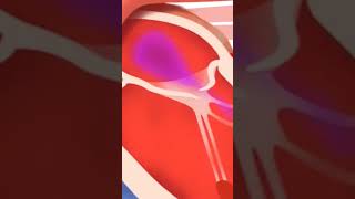 Mitral Valve Regurgitation Short Video [upl. by Drawyah509]