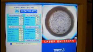 Myoring implantation after Intralase pocket creation [upl. by Mendel]