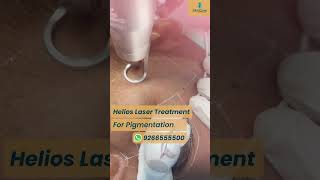 Helios laser treatment for Pigmentation  Removes Dark Spots amp Blemishes at SkinQure  Delhi [upl. by Kenaz]