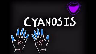 Cyanosis CauseTypesClinical features [upl. by Irok]