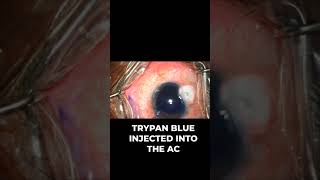 Checking the Patency of Trabeculectomy Bleb while doing Cataract Surgery [upl. by Beret]