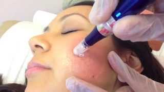 Micro Needling SkinPen for acne scarring [upl. by Eugenle649]