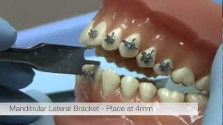 American Orthodontics Alexander LTS Brackets  Bracket Placement Video [upl. by Rivi]