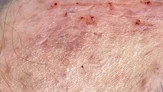 Poping zits around blackheads poping part 04 [upl. by Oriane914]