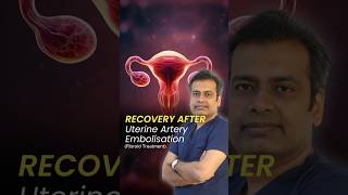 Recovery after Uterine Artery Embolisation  Recovery Time after Uterine Fibroid Embolization UFE [upl. by Lauber]