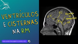 Ventrículos e Cisternas Cerebrais por RM [upl. by Marva496]