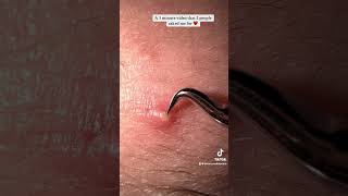 Pimple Popping With The Viral Tweezers Satisfying Extractions [upl. by Naivart661]