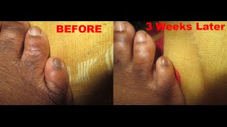 Pinky Toe Is Black  Cure Dark Black Toenails Naturally [upl. by Nevanod]