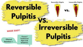 Reversible Pulpitis vs Irreversible Pulpitis  Endodontics [upl. by Sunderland]