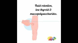 Fluid retention  edema  low thyroid [upl. by Okiron]