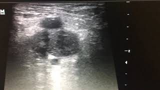 Compression ultrasound CUS in sospetta embolia polmonare [upl. by Bagger53]