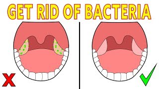 The 3 minute natural method to get rid of tonsil stone bacteria [upl. by Jens]