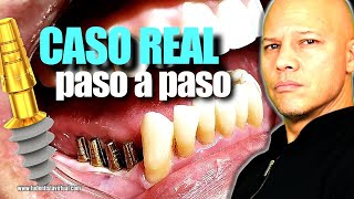 LA REALIDAD de los IMPLANTES MONOFASICOS LO QUE NUNCA MUESTRAN [upl. by Idnat116]