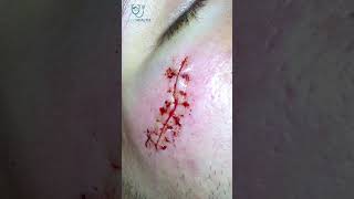 How many TYPES of stitches are in surgery  DrBadareesh Koganti  stitches absorbablestitches [upl. by Elephus417]