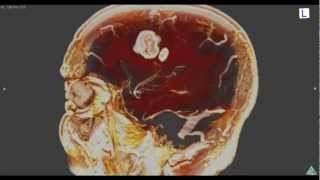 Brain Tumor 3D MRI：脳腫瘍を造影してみた [upl. by Prendergast]