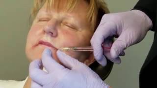 A Live VOLBELLA® Treatment for Fuller Lips [upl. by Hardy483]